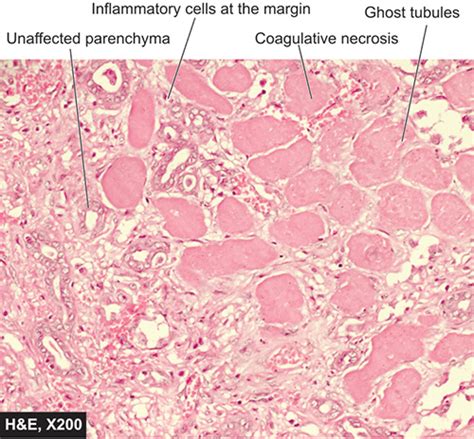 Pale Infarct Kidney