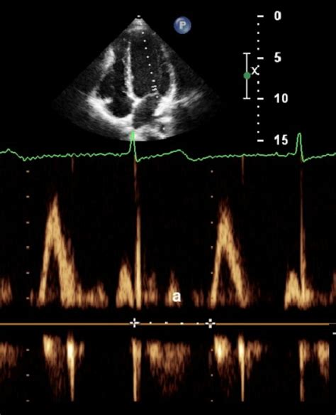 Measurement of interval (a) which includes the isovolumic contraction ...