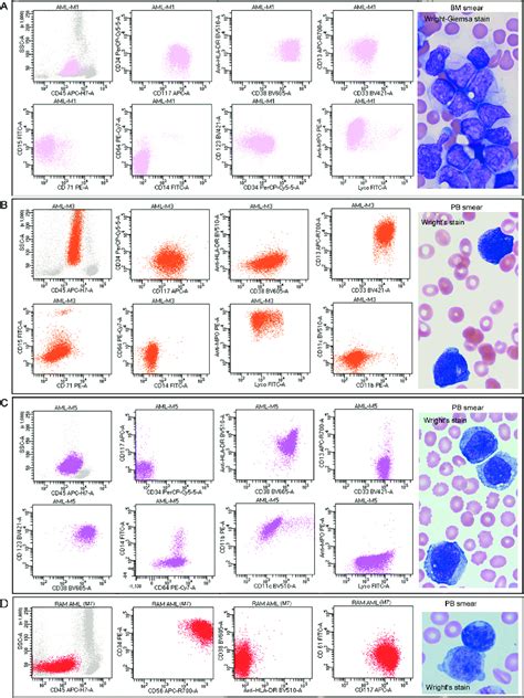 Acute Myeloid Leukemia Representative Flow Cytometry Dot Plots And