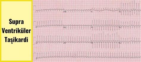 SVT Nedir Supraventriküler Taşikardinin Tanımı Nedenleri ve Tedavisi