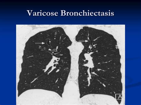 Mild Cylindrical Bronchiectasis Comprehensive Guide To Treatment