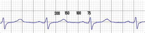 Mcgill Ekg Learning Project