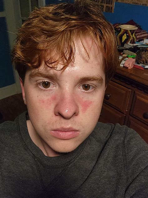 [routine Help] Redness On Face R Skincareaddiction