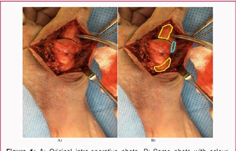 Figure 1 From Palmar Dislocation With Extensor Tendon Interposition And