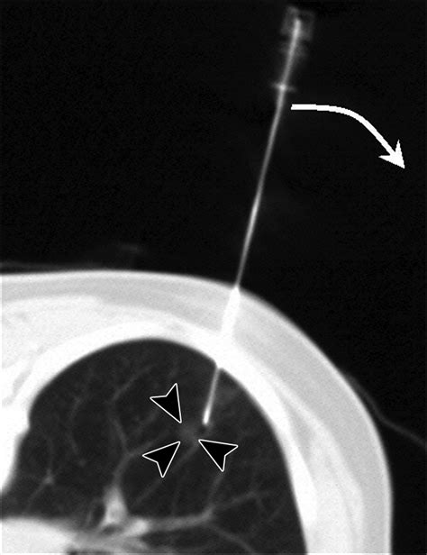 Ct Guided Core Biopsy Of Lung Lesions A Primer Ajr