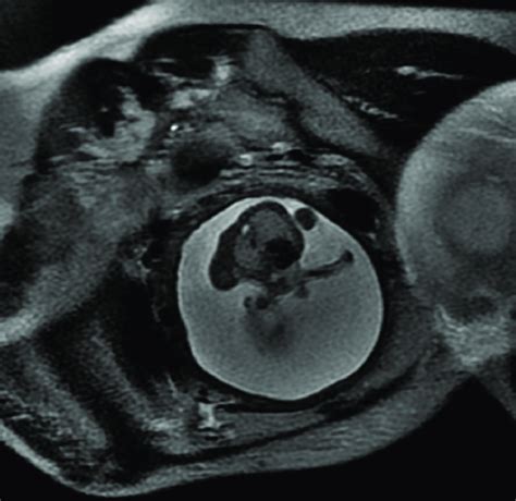 SSFSE/T2/ax. Case 13. Unusual pair of conjoined twins: twin I was ...