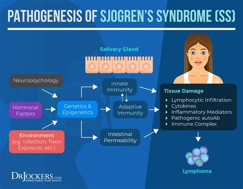 Sjogren’s Syndrome: Symptoms, Causes, and Natural Support Strategies ...