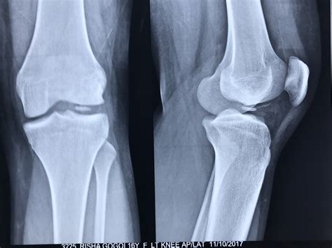 11 questions with answers in KNEE ARTHROSCOPY | Science topic