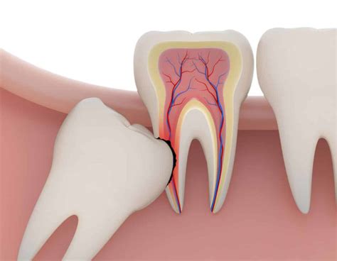 Quando Se Deve Extrair O Dente Siso Dr Tulio Andrade