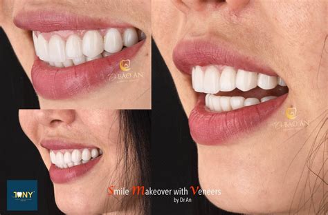 Smile Makeover With Veneer