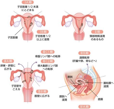 子宮体がんの広がり方 子宮体がん Msd Oncology がんを生きる