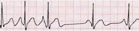 ECG / EKG Rhythms: AmperorDirect