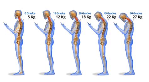 Dolor De Cuello Por Mala Postura Ana Quiropractica Tu Quiropractico