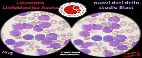 Leucemia Linfoblastica Acuta Versus Blast ASSOCIAZIONE AMICI DELLA