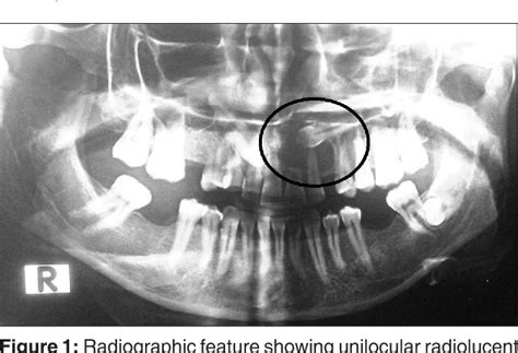 Figure 1 From A Case Of Central Mucoepidermoid Carcinoma Associated With Dentigerous Cyst