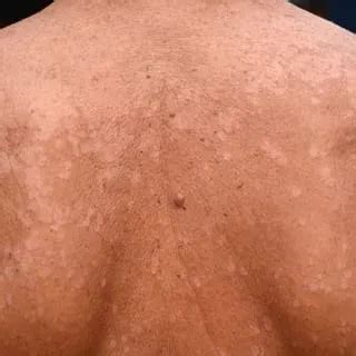 Tinea Versicolor Dermatology Located In Fairfax VA Integrated