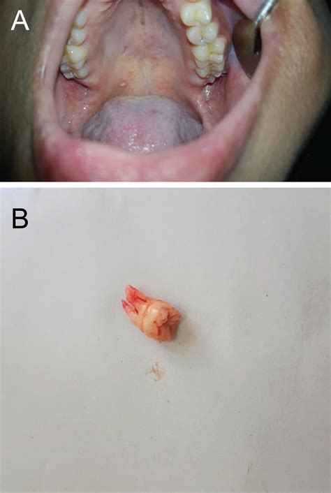 Cellulitis And Abscess Of Mouth