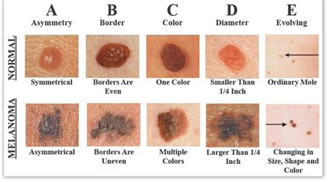 Malignant Melanoma Mc Medical Group