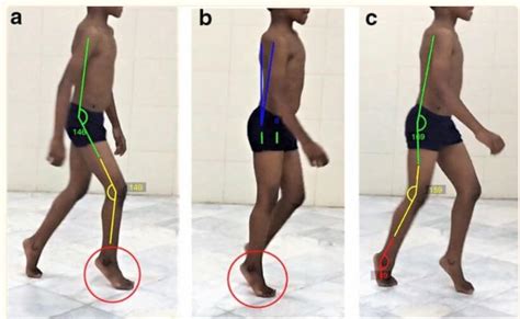 Edinburgh Visual Gait Scale