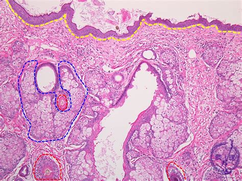 Ovarian Cyst Histology