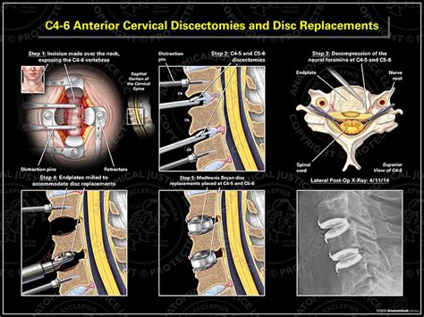 C4 6 Anterior Cervical Discectomies And Disc Replacements