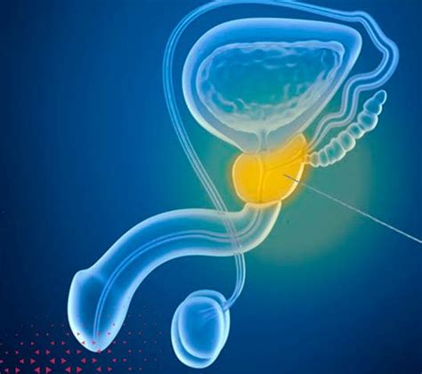 Biópsia Transperineal da Próstata Dr Bruno Farnese