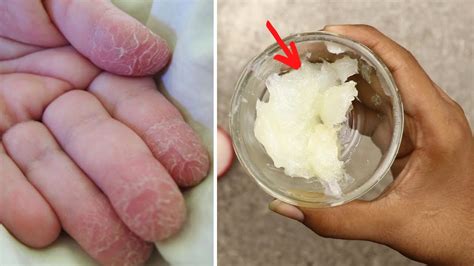 Fix Dry Severely Cracked Hands And Skin Peeling From Fingers Naturally