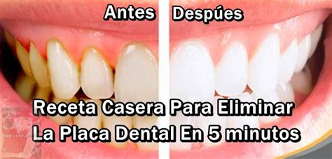 Tan Solo Amor COMO ELIMINAR LA PLACA DENTAL EN 5 MINUTOS SIN IR AL