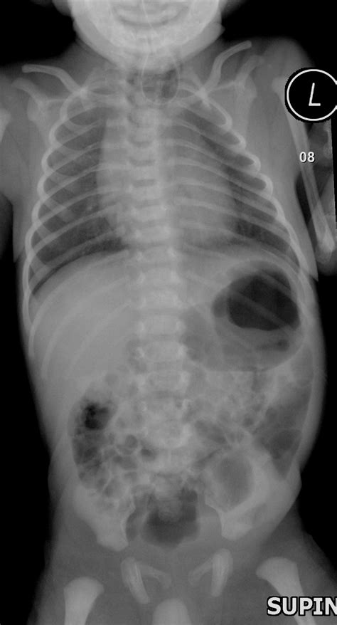 Tracheoesophageal Fistula Radiology