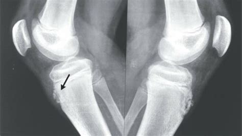 Morbo Di Osgood Schlatter Fisioscience