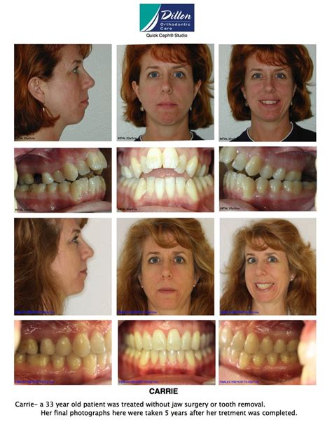 Gallery Invisalign Near Me Dillon Orthodontic Care