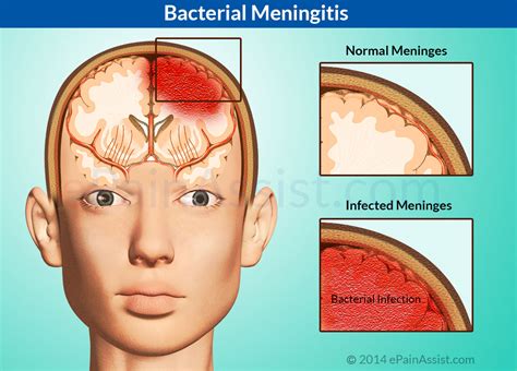 Meningite A Inflama O Das Meninges Meningitis Bacterial Hot Sex Picture