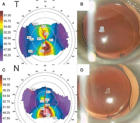 Cataract Surgery In The Keratoconus Patient Ento Key