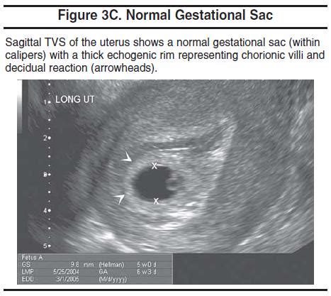 Gestational Sac Ultrasound