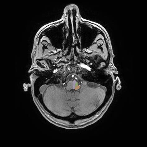 Arterial Territories Of The Brain Stroke Manual