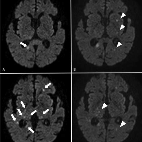 Brain Magnetic Resonance Imaging With Diffusion Weighted Imaging