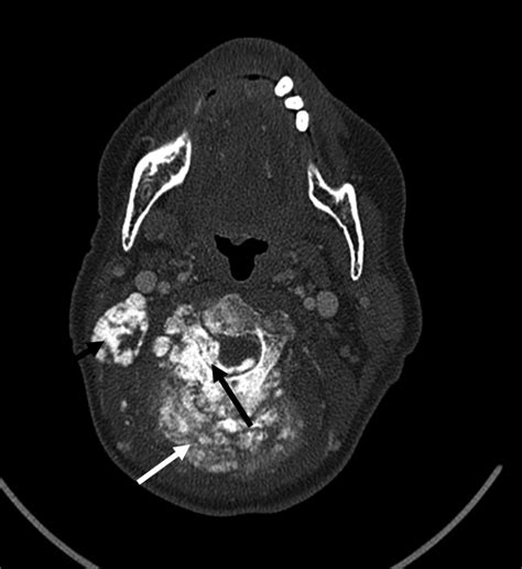 Axial Ct Bone Window With Contrast Of The Upper Neck Shows A Tumor