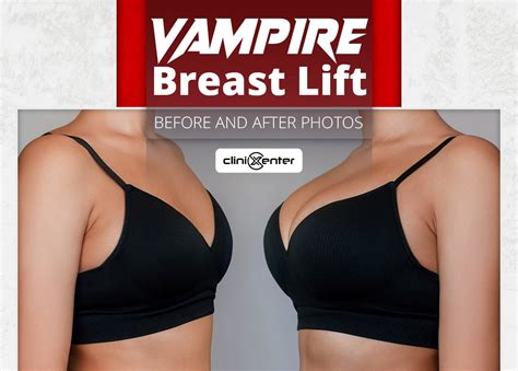 Vampire Breast Lift Before And After Photos Clinixenter