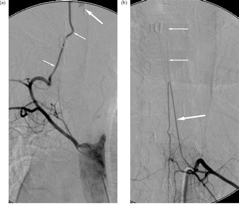 Bronchial Artery Embolization