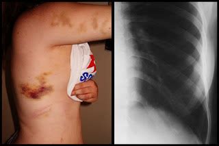 Broken Rib Symptoms and Treatment: Broken Rib Symptoms