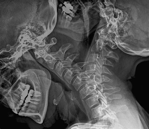 Flexion Extension X Ray Cervical Spine Rillylime