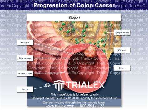 Progression Of Colon Cancer Stage I Trialquest Inc