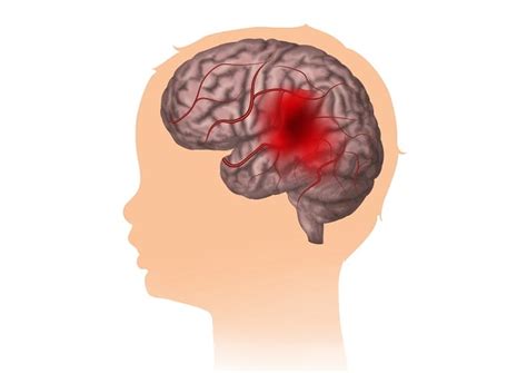 Stroke Pada Anak Patofisiologi Diagnosis Penatalaksanaan Alomedika