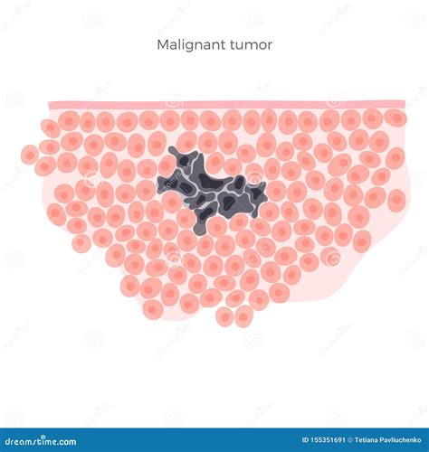 Illustration D Isolement Par Vecteur De Tumeur Maligne Illustration De