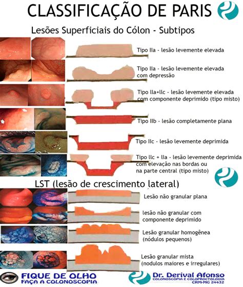 Colonoscopia No Tratamento Das Doencas Colorretais Colonoscopia