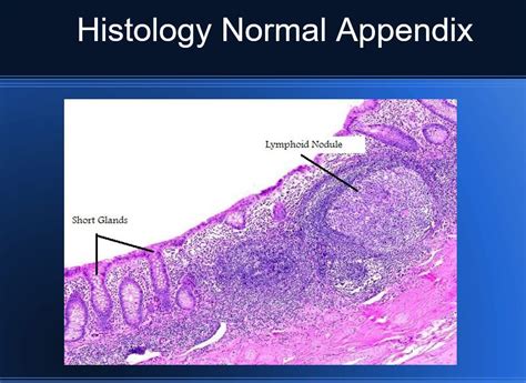 Pathology of Acute Appendicitis - Its Etiology, Morphology, Gross ... 