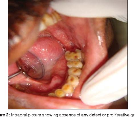 Primary Intraosseous Carcinoma Of Mandible A Case Report Semantic