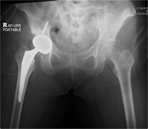 Early Intraprosthetic Dislocation After Closed Reduction In Modern Dual