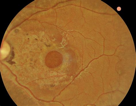 Surgical Repair Of Spontaneous Full Thickness Macular Holes Can Improve