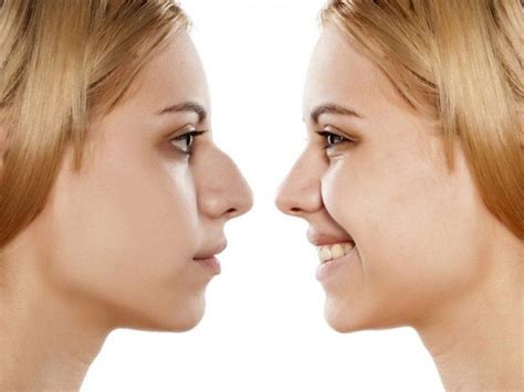 Tout Savoir Sur La Rhinoplastie Conservatrice Chirurgie Visage Hot